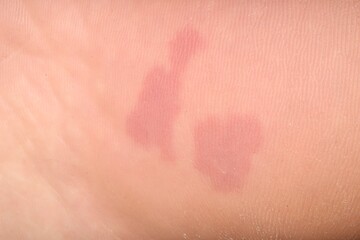 Fototapeta premium Macro view of dry human skin with red spots as background