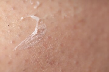 Closeup view of woman with dry skin