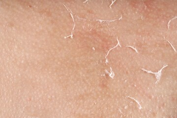 Closeup view of woman with dry skin