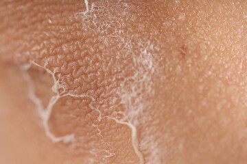 Fototapeta premium Woman with dry skin on her elbow, closeup