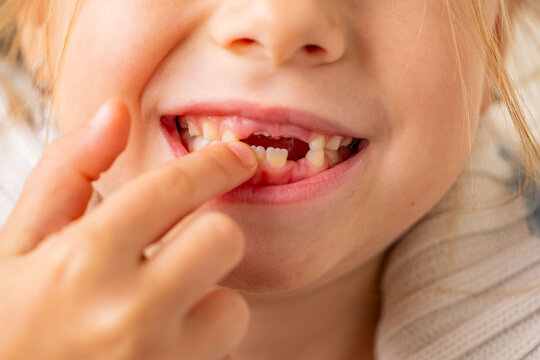funny toothless 6-year-old girl, touching wobbly tooth, child baby tooth fell out, childhood moment waiting for toothfairy, growing up, cute Toothless smile expression, innocence and joy childhood