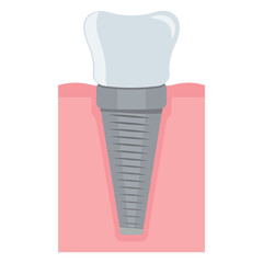 Dental implant. Screw prosthesis, Illustration of dental implantation,orthodontic dental implantation