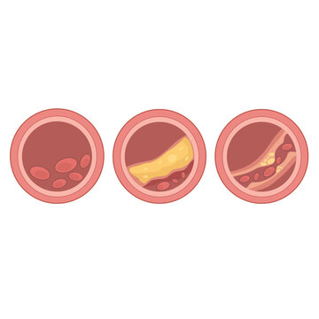 Detailed vector illustration of fat cells and cholesterol buildup inside a human blood vessel, designed for educational, medical, and anatomical learning or simulation purposes.