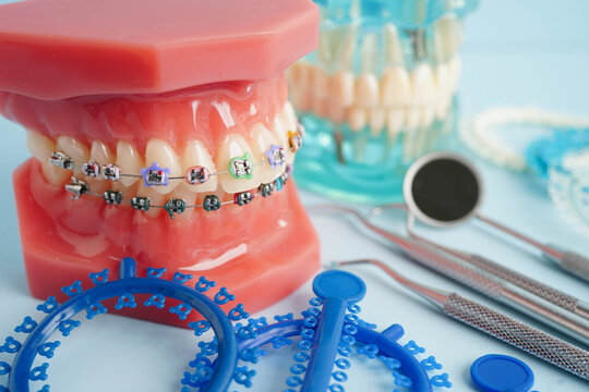 Orthodontic ligatures rings and ties, elastic rubber bands on orthodontic braces, model for dentist studying about dentistry.