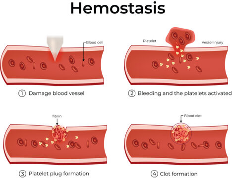 Hemostasis, Blood Vessel Injury, Platelet Plug Formation, and Coagulation Vector Illustration.