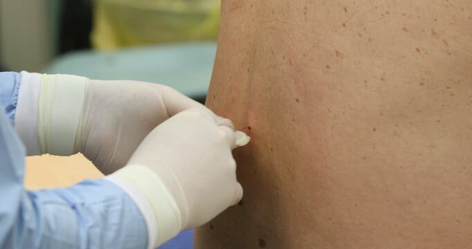 A doctor's hands in sterile gloves place an epidural catheter in a patient's back for anesthesia.