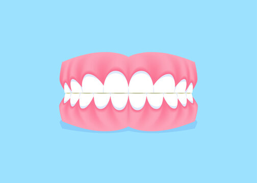 Full mouth teeth - Attrition illustration vector design. Dental care concept.