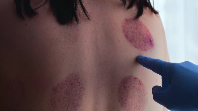 A girl after a cupping massage on her back.
Bruises on her body after a vacuum massage.
Bruising on the skin after a cupping massage.
Massage, health, medicine, treatment, scoliosis