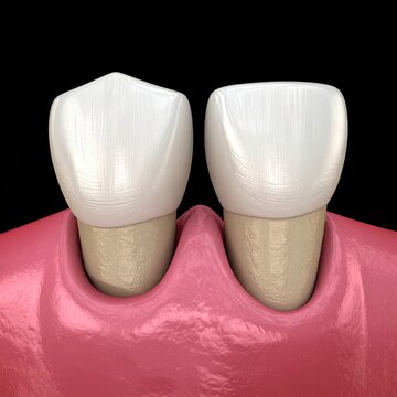 Human front teeth, gums depicted against a dark backdrop