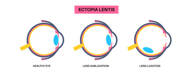 Ectopia lentis disease