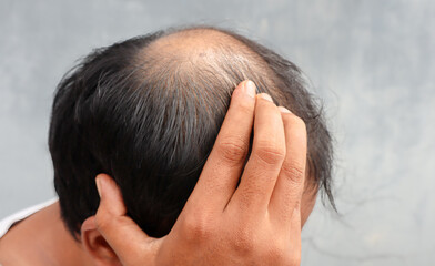 Fototapeta premium Asian Man with hair loss problems closeup,isolated. Alopecia balding hairs on man scalp. Human alopecia or hair loss-person hand pointing his bald head. Scratching his head. Baldness.Depression,stress