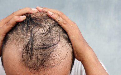 Fototapeta premium Asian Man with hair loss problems closeup,isolated. Alopecia balding hairs on man scalp. Human alopecia or hair loss-person hand pointing his bald head. Scratching his head. Baldness.Depression,stress