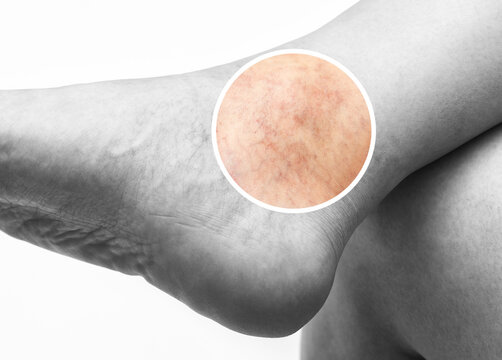 Man shows  the dilation of small blood vessels of the skin on the leg. Medical inspection and treatment of Telangiectasia.