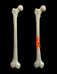 Femur bone with shaft fracture, 3D illustration