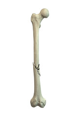 Femur shaft fracture, 3D illustration