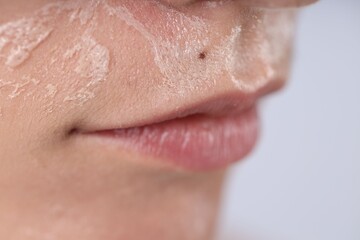 Woman with dry skin on her face against light background, closeup