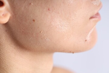 Fototapeta premium Woman with dry skin on her face against light background, closeup