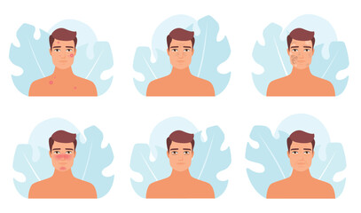 Obraz premium Male skin problem set vector illustration. Cartoon man with different types of medical troubles with skin collection, dark circle under eyes and wrinkles, acne and melasma, blackheads and rosacea