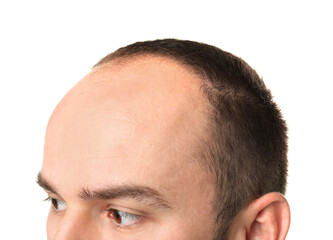 Fototapeta premium Baldness problem. Man with receding hairline on white background, closeup