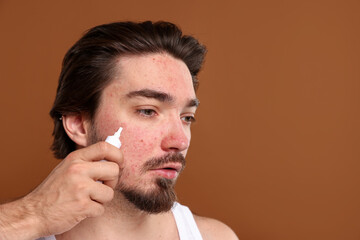 Obraz premium Young man with acne problem applying cream onto his face on brown background. Space for text