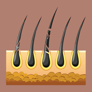 Cross-section graphic of damaged hair follicles and shafts indicating hair breakage or unhealthy growth due to stress