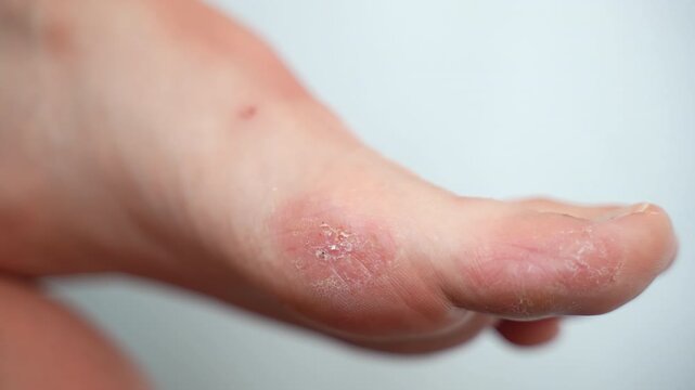 Patient's foot against white background with acute symptoms of dermatological disease, serious skin inflammation caused by chronic stress, moisture or allergy reaction, redness, dry skin, wounds and
