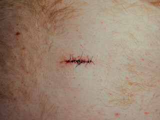 Close up of stitches from a cut on the skin