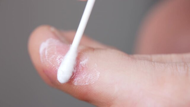 Medical treatment of acute eczema, dyshidrosis or psoriasis with steroid cream or ointment, person applying healing medicine on inflamed toe skin, dermatological disease caused by chronic stress or