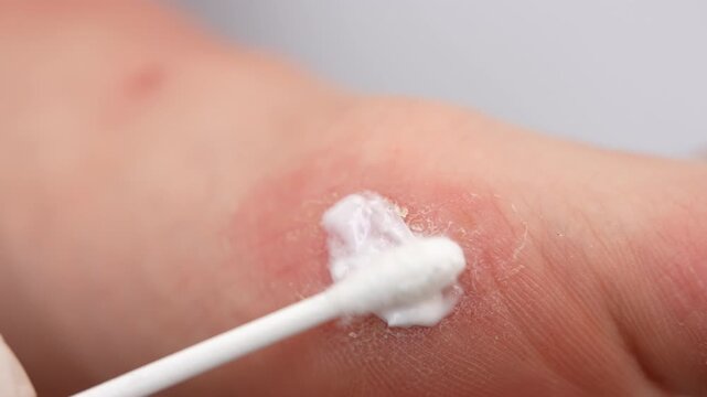 Itchy dyshidrosis on human foot, applying symptoms relief ointment during acute phase of skin inflammation, red rashes and fluid blisters irritating epidermis and leading to serious dermatological
