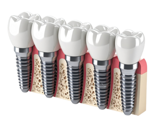 Dental implants in a cross-section of the jawbone