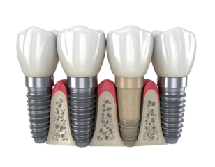 Dental implants in gums. 3D illustration