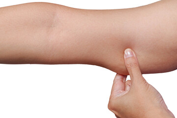 A woman holding, pulling the skin on her arm exces loose skin.