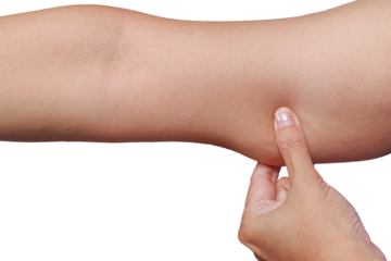 A woman holding, pulling the skin on her arm exces loose skin.