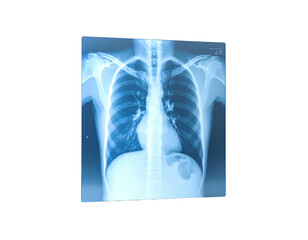 Radiographic view of the human chest, showing bones and internal organs