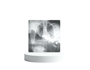 Medical chest x-ray displayed on a white podium, against a black backdrop