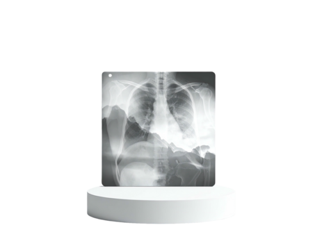 Medical chest x-ray displayed on a white podium, against a black backdrop