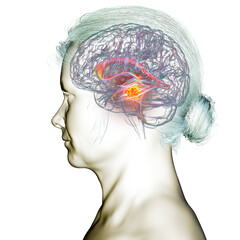 A brain tumor causing hydrocephalus, 3D illustration