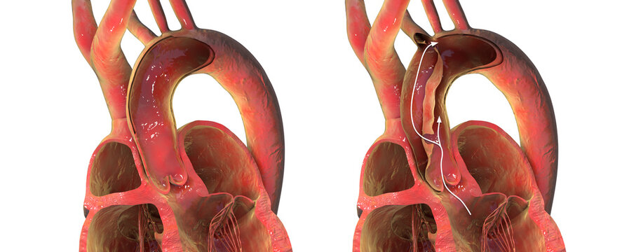 Normal aorta compared with aortic dissection, 3D illustration