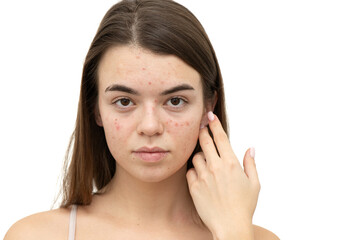 Portrait of young woman with acne on her face. Acne, skin care concept. Real photo.