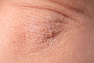 Texture of dry skin as background, closeup