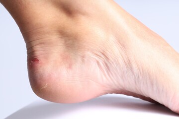 Woman with dry skin on her foot against light background, closeup