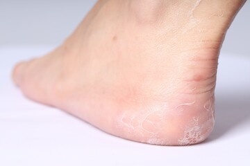 Woman with dry skin on her foot against light background, closeup