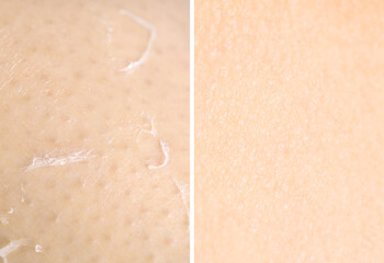 Dry skin on one side and moisturized on another, collage before and after
