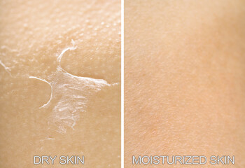Fototapeta premium Dry skin on one side and moisturized on another, collage before and after