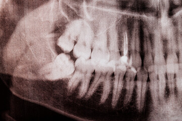 Lower impacted wisdom tooth pushing the rest of the teeth on x-ray, close-up