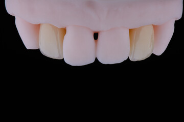 High-quality dental single crowns made of zirconium for fixation to the frontal teeth of upper jaw.