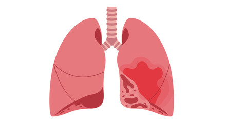 Detailed human lungs showcasing respiratory system health and potential disease indicators for medical education and awareness campaigns