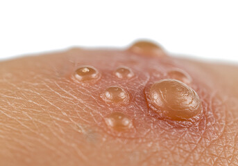 Fototapeta premium Close-up image of skin with blisters illustrating a skin condition, possibly burns or allergic reaction with fluid filled vesicles.