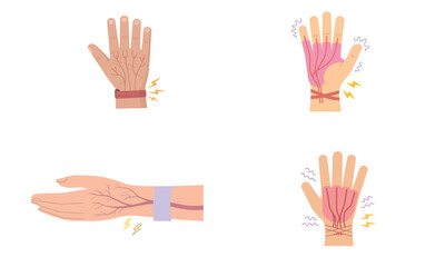 Fototapeta premium Vector medical illustration of hand pain with anatomy muscles and carpal tunnel syndrome 