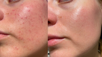 Close-up comparison of female cheek skin before and after care. Acne, redness, and blemishes reduced, showing clear and smooth result. Dermatology, skincare, beauty treatment.
